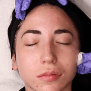 Deluxe Chemical Peel Series at Empowered Esthetic in Rancho Santa Margarita, CA